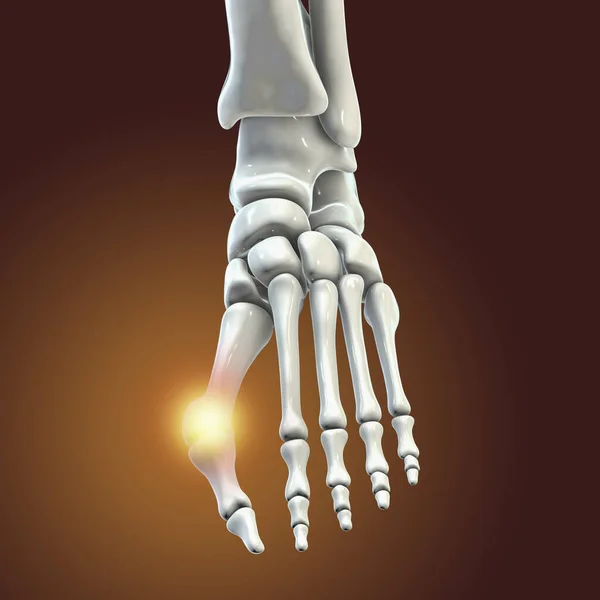 Zehendeformation Auch Als Hallux Valgus Oder Ballenballen Bekannt Illustration — Stockfoto