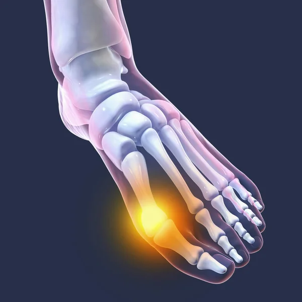 Παραμόρφωση Των Ποδιών Επίσης Γνωστή Hallux Valgus Bunion Εικονογράφηση — Φωτογραφία Αρχείου