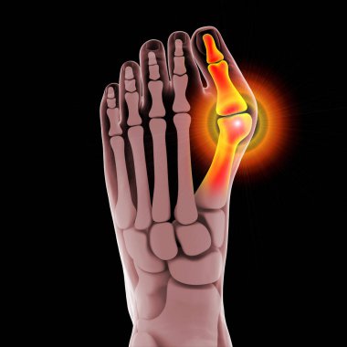 Ayak parmağı deformasyonu, hallux valgus olarak da bilinir, ya da nasır, 3 boyutlu illüstrasyon.