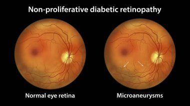 Yaygın olmayan diyabetik retinopati, optalmoskop görüntüsü, göz retinası ve retinayı birden fazla mikroanevrizma (kırmızı noktalar) ile gösteren illüstrasyon (kırmızı noktalar))