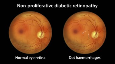 Yaygın olmayan diyabetik retinopati, optalmoskop görüntüsü, göz retinasını ve retinasını birden fazla nokta kanamasıyla gösteren çizimler (kırmızı noktalar))