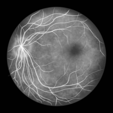 Normal göz retinası, optik diski, kan damarlarını, makulayı ve foveayı gösteren bilimsel çizimler, oftalmoskop görüntüsü, floresein anjiyografisi.
