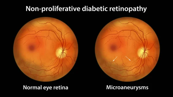 Retinopatía Diabética Proliferativa Vista Oftalmoscópica Ilustración Que Muestra Retina Ocular — Foto de Stock