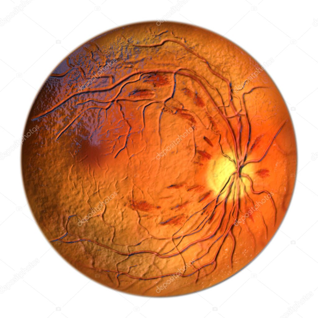Non-proliferative diabetic retinopathy, 3D illustration showing flame-shaped and splinter retinal haemorrhages, ophthalmoscope view