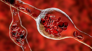 Mikroanevrizmalar, atardamar duvarlarında kanla dolu mikroskobik çıkıntılar, üç boyutlu çizimler. Göz retinasında retinopatide ve beyinde de bulunur (Charcot-Bouchard anevrizması)