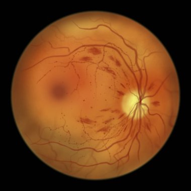 Yaygın olmayan diyabetik retinopati, mikro anevrizmaları gösteren illüstrasyon, nokta kanamalar, alev şeklinde ve ayrık retinal kanamalar, göz makyajı.