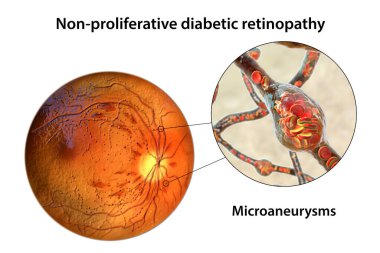 Yaygın olmayan diyabetik retinopati, göz retinasında çoklu mikroanevrizma ve mikroanevrizma görüntülerini gösteren üç boyutlu illüstrasyon, atardamar duvarlarında kanla dolu mikroskobik çıkıntılar.