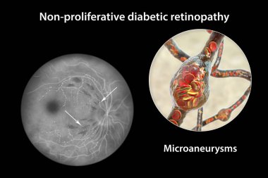 Yaygın olmayan diyabetik retinopati, göz retinasında çoklu mikroanevrizma ve mikroanevrizma görüntülerini gösteren üç boyutlu illüstrasyon, atardamar duvarlarında kanla dolu mikroskobik çıkıntılar.