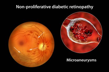 Yaygın olmayan diyabetik retinopati, göz retinasında çoklu mikroanevrizma ve mikroanevrizma görüntülerini gösteren üç boyutlu illüstrasyon, atardamar duvarlarında kanla dolu mikroskobik çıkıntılar.