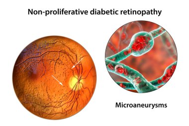 Yaygın olmayan diyabetik retinopati, göz retinasında çoklu mikroanevrizma ve mikroanevrizma görüntülerini gösteren üç boyutlu illüstrasyon, atardamar duvarlarında kanla dolu mikroskobik çıkıntılar.
