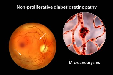 Yaygın olmayan diyabetik retinopati, göz retinasında çoklu mikroanevrizma ve mikroanevrizma görüntülerini gösteren üç boyutlu illüstrasyon, atardamar duvarlarında kanla dolu mikroskobik çıkıntılar.