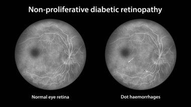 Yaygın olmayan diyabetik retinopati, optalmoskop görüntüsü, göz retinasını ve retinasını birden fazla nokta kanamasıyla gösteren illüstrasyon (koyu gri noktalar))