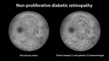 Yaygın olmayan diyabetik retinopati, optalmoskop görüntüsü, göz retinasını ve retinasını alev şeklinde ve kıymık şeklinde kanamalarla gösteren illüstrasyon.