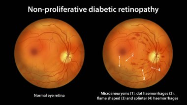 Üretken olmayan diyabetik retinopati, mikro anevrizmalı normal göz retinası ve retinayı gösteren çizimler, nokta kanamalar, alev şeklinde ve ayrık retinal kanamalar, göz makyajı