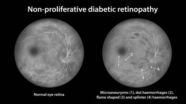 Üretken olmayan diyabetik retinopati, mikro anevrizmalı normal göz retinası ve retinayı gösteren illüstrasyon, nokta kanamalar, alev şeklinde ve ayrık retina kanamaları, florasan anjiyografisi