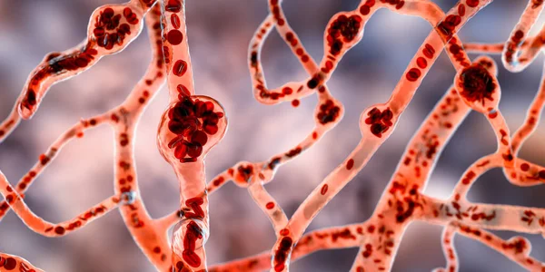 Microaneurysms Microscopic Buldges Artery Walls Filled Blood Illustration Found Eye — Stock Photo, Image