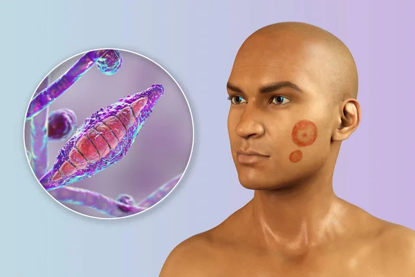 人脸上的小孢子犬菌感染和小孢子犬菌的特写 3D说明 Ringworm Tinea Faciei — 图库照片