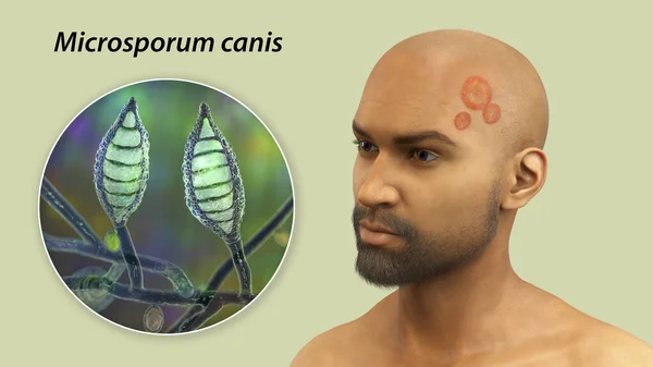 Microsporum Canis Fungal Infection Man Head Close View Microsporum Canis — Stock Photo, Image