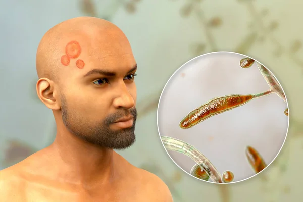 Fungal Infection Man Head Face Illustration Man Tinea Capitis Tinea — ストック写真