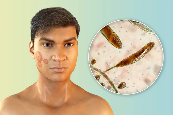 Fungal infection on a man\'s face, 3D illustration of a man with Tinea faciei and close-up view of fungi Trichophyton rubrum