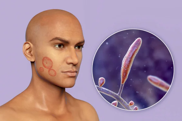 男人脸上的真菌感染 Tinea Faciei男人的3D图像和Trichophyton Rubrum真菌的特写 — 图库照片