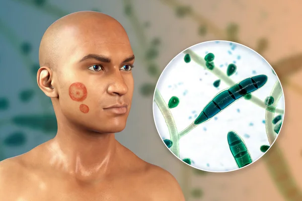 Fungal infection on a man\'s face, 3D illustration of a man with Tinea faciei and close-up view of fungi Trichophyton rubrum