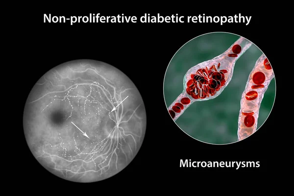 Yaygın Olmayan Diyabetik Retinopati Göz Retinasında Çoklu Mikroanevrizma Mikroanevrizma Görüntülerini — Stok fotoğraf