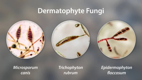 Dermatophyte Fungi Illustration Microsporum Trichophyton Epidermophyton Causative Agents Ringworm Tinea — Stock Photo, Image