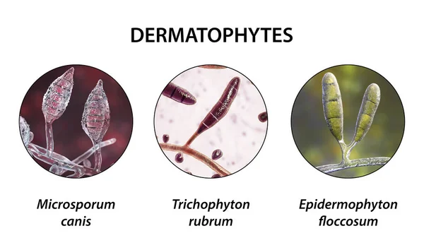 Dermatophyte Μύκητες Εικόνα Microsporum Trichophyton Και Epidermophyton Αιτιολογικοί Παράγοντες Της — Φωτογραφία Αρχείου