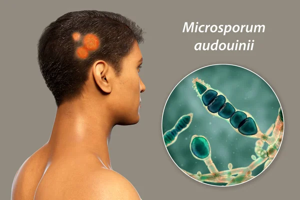 Fungal infection on a man\'s head, 3D illustration of a man with Tinea capitis and close-up view of fungi Microsporum audouinii