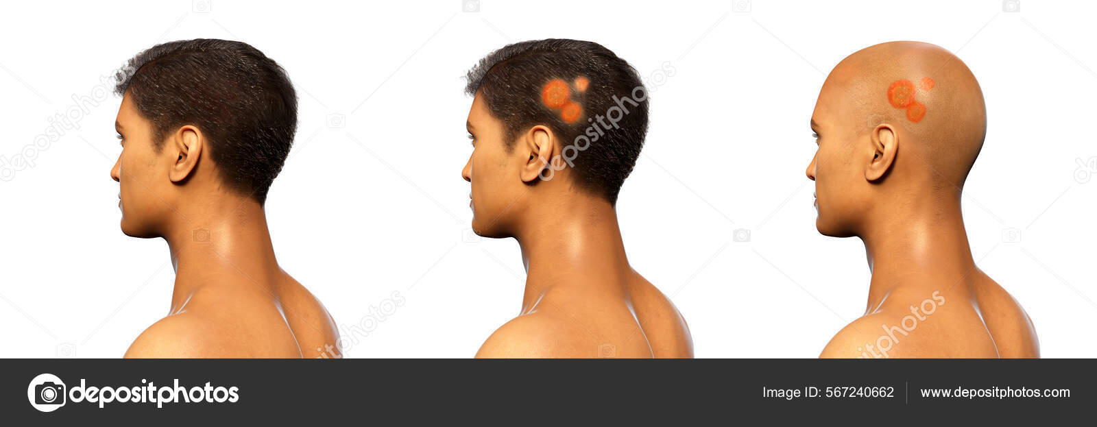 Fungal Infection Man's Head Illustration Tinea Capitis Caused Fungi  Microsporum fotos, imagens de © katerynakon #567240662