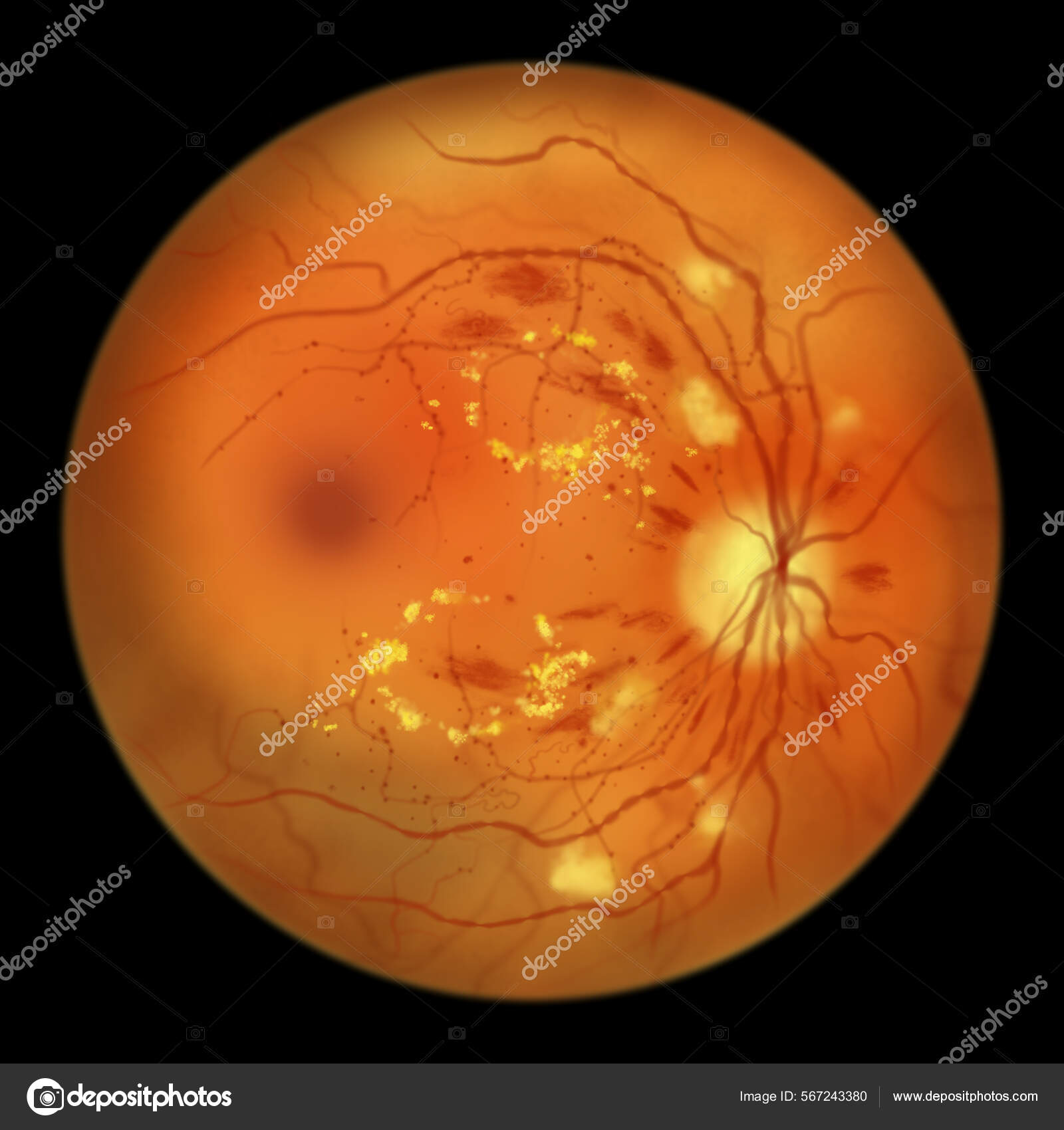Diabetic Retinopathy Non Proliferative Illustration Showing Hard