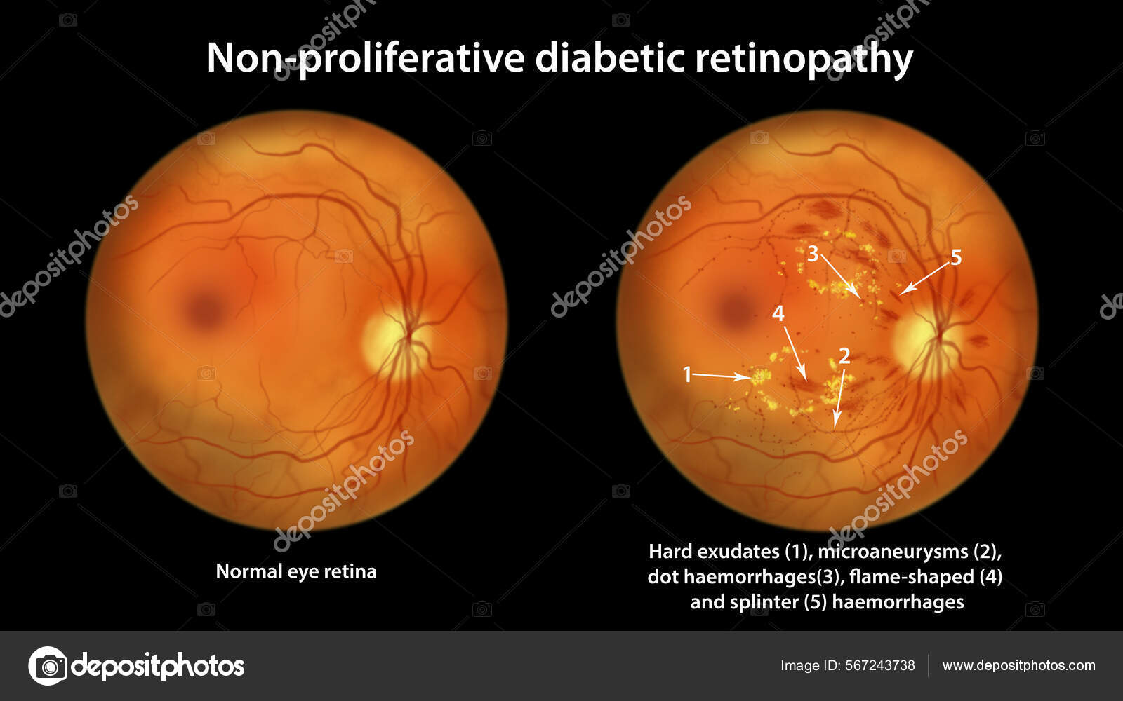 Non Proliferative Diabetic Retinopathy Illustration Showing Normal.