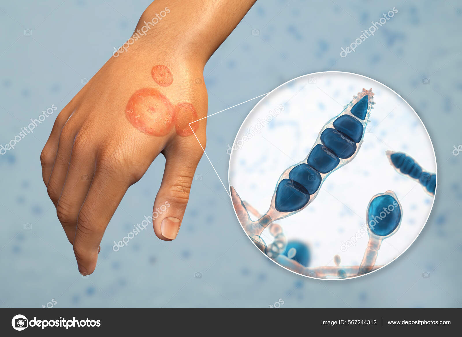 Fungal Infection Man's Hand Tinea Manuum Close View Dermatophyte