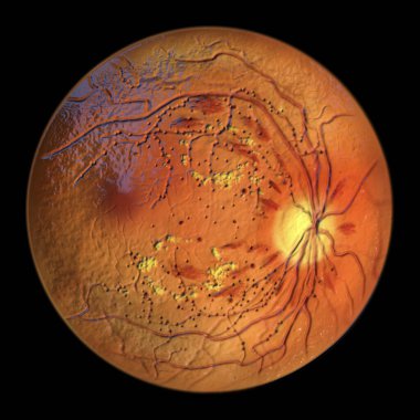 Non-proliferative diabetic retinopathy, 3D illustration showing hard exudates, microaneurysms, dot haemorrhages, flame-shaped and splinter retinal haemorrhages, ophthalmoscope view clipart