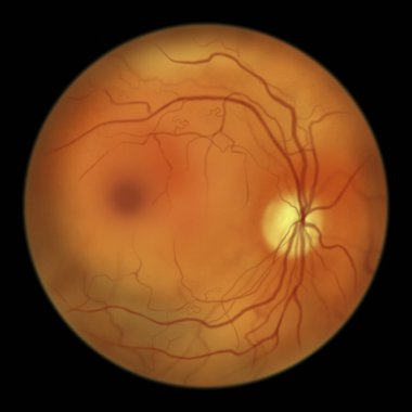 Yaygın olmayan diyabetik retinopati, İRA 'ları (intraretinal mikrovasküler anormallikler) iskemik bölgelerde anormal dallanma veya genişleme gösteren küçük damarlar olarak göstermektedir.