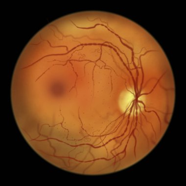 Non-proliferative diabetic retinopathy, illustration showing IRMAs (intraretinal microvascular abnormalities), venous beading, and microaneurysms
