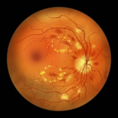 Diabetic retinopathy non-proliferative, illustration showing hard exudates, cotton wool spots, microaneurysms, dot haemorrhages, flame-shaped and splinter retinal haemorrhages, IRMAs, venous beading