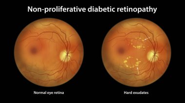 Üretken olmayan diyabetik retinopati, göz retinasını ve retinasını sert ekzosenlerle gösteren illüstrasyon (düzensiz şekilli sarı noktalar))