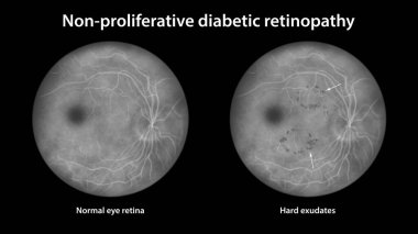 Üretken olmayan diyabetik retinopati, göz retinasını ve retinasını sert çıkıntılı (düzensiz şekilli koyu lekeler) gösteren illüstrasyon, floressein anjiyografisi