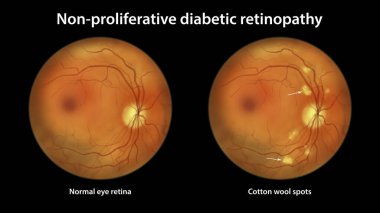 Non-proliferative diabetic retinopathy, illustration showing normal eye retina and retina with cotton wool spots as fluffy yellow patches