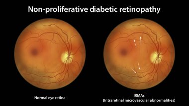 Yaygın olmayan diyabetik retinopati, lRA 'lı normal göz retinası ve retinayı (intraretinal mikrovasküler anormal dallanma) küçük damarlar olarak gösteren illüstrasyon