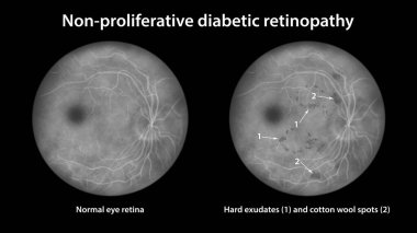 Üretken olmayan diyabetik retinopati, göz retinasını ve retinasını sert çıkıntılarla gösteren çizimler, ve pamuk yün lekeleri, floresan anjiyografisi.