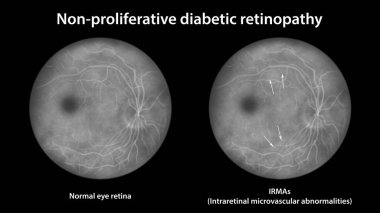 Yaygın olmayan diyabetik retinopati, lRA 'lı normal göz retinası ve retinayı gösteren illüstrasyon (intraretinal mikrovasküler anormallikler), floressein anjiyografisi