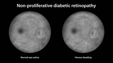 Yaygın olmayan diyabetik retinopati, göz retinasını ve retinasını venöz boncuklu, floresein anjiyografisi ile gösteren çizimler.