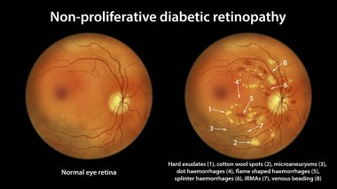 Diabetic retinopathy non-proliferative, illustration showing hard exudates, cotton wool spots, microaneurysms, dot haemorrhages, flame-shaped and splinter retinal haemorrhages, IRMAs, venous beading