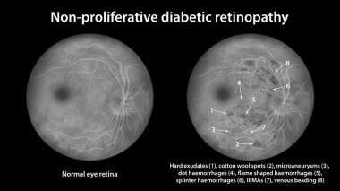 Diyabetik retinopati üretici değil, sert üreme, pamuk lekeleri, mikroanevrizmalar, kanamalar, IRMA 'lar ve venöz boncuklama, floressein anjiyografisini gösteren illüstrasyon.