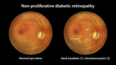 Non-proliferative diabetic retinopathy, illustration showing normal eye retina and retina with hard exudates and microaneurysms