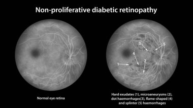 Üretken olmayan diyabetik retinopati, göz retinası ve retinayı sert bir şekilde dışa doğru gösteren çizimler, mikroanevrizmalar, nokta kanamalar, alev şeklinde alevler ve retinal kanamalar.