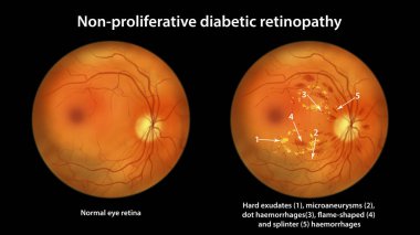 Üretken olmayan diyabetik retinopati, göz retinası ve retinayı sert bir şekilde dışa doğru gösteren çizimler, mikroanevrizmalar, nokta kanamalar, alev şeklinde alevler ve retinal kanamalar.